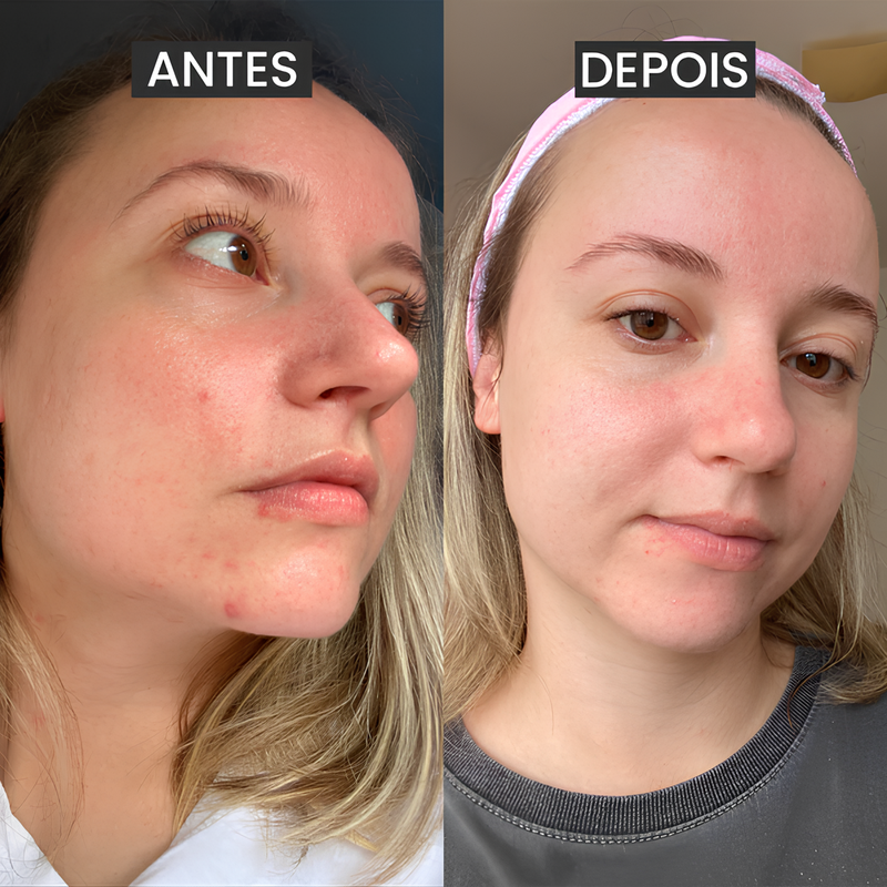 Creme Anti-idade Renew Skin® - [ÚLTIMAS UNIDADES]