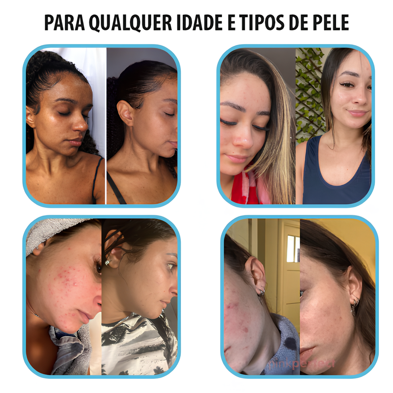 Creme Anti-idade Renew Skin® - [ÚLTIMAS UNIDADES]